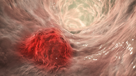 أطعمة تعزز دفاعات الجسم ضد السرطان